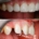 Художественная реставрация передних зубов, зона улыбки