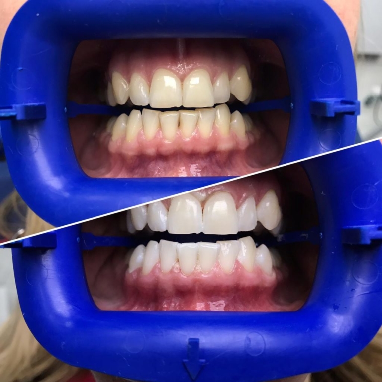 Отбеливание зубов системой zoom зарядное устройство для ирригатора revyline