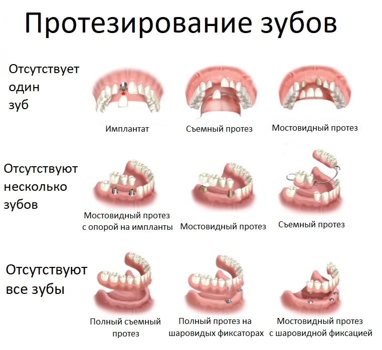 виды зубных протезов