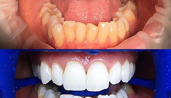 Отбеливание зубов ZOOM 4 фото до и после