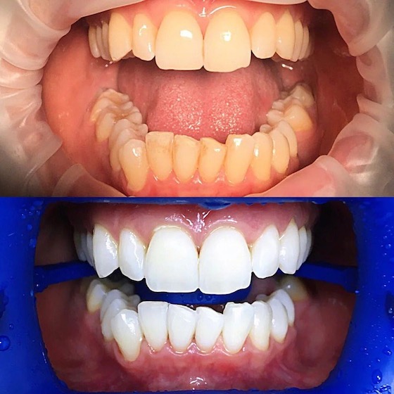 Отбеливание зубов ZOOM 4 фото до и после